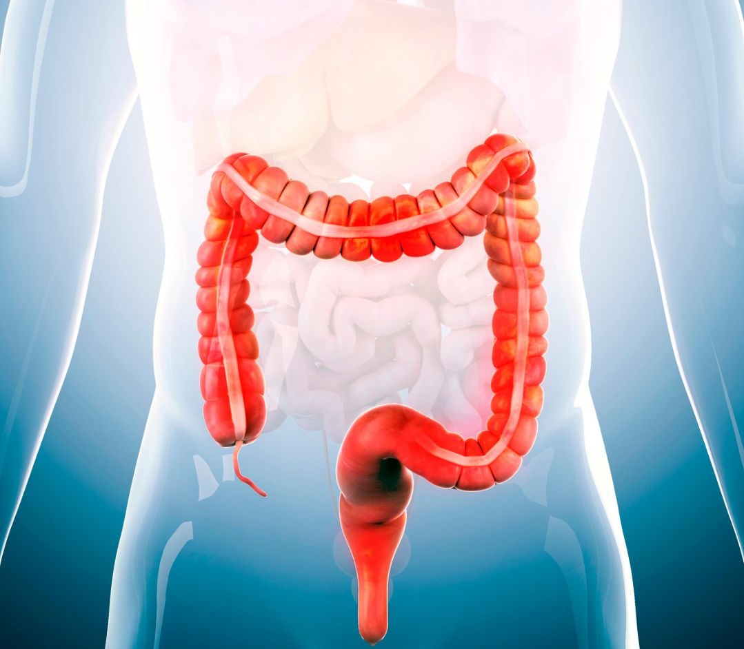 Homeopathic treatment for Irritable Bowel Syndrome (IBS) and chronic stomach pain